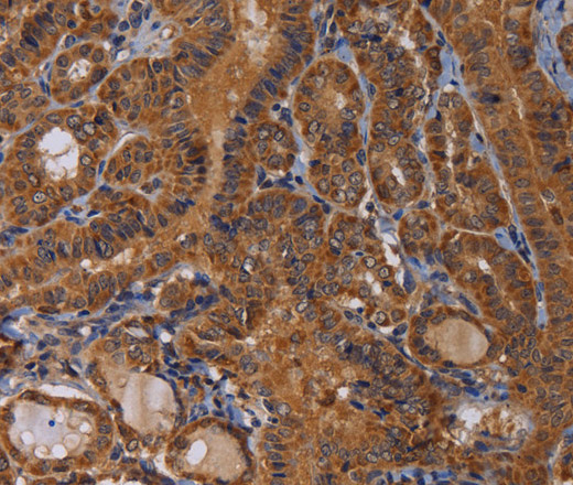 Immunohistochemistry of paraffin-embedded Human thyroid cancer tissue using MAGEB10 Polyclonal Antibody at dilution 1:60