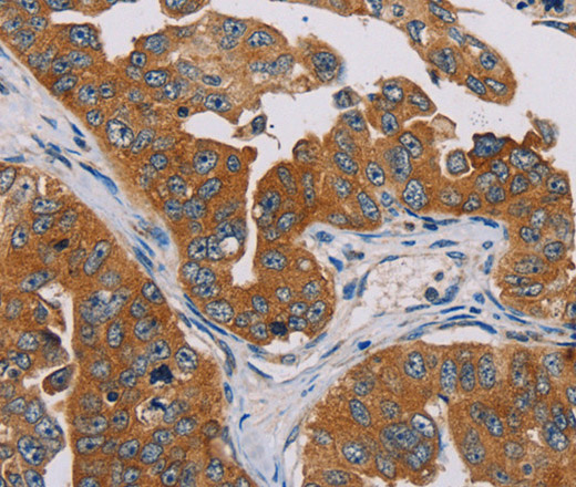 Immunohistochemistry of paraffin-embedded Human cervical cancer tissue using MBNL3 Polyclonal Antibody at dilution 1:30