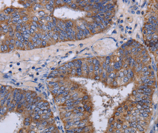 Immunohistochemistry of paraffin-embedded Human colon cancer tissue using MT3 Polyclonal Antibody at dilution 1:50