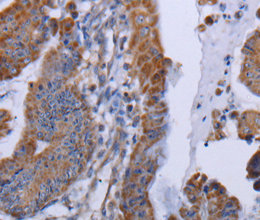 Immunohistochemistry of paraffin-embedded Human esophagus cancer tissue using MT3 Polyclonal Antibody at dilution 1:50