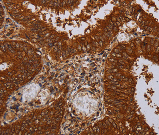 Immunohistochemistry of paraffin-embedded Human colon cancer tissue using MFAP3L Polyclonal Antibody at dilution 1:50