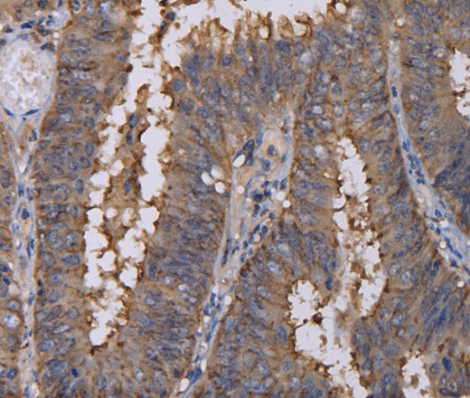 Immunohistochemistry of paraffin-embedded Human colon cancer using REG3G Polyclonal Antibody at dilution of 1:40