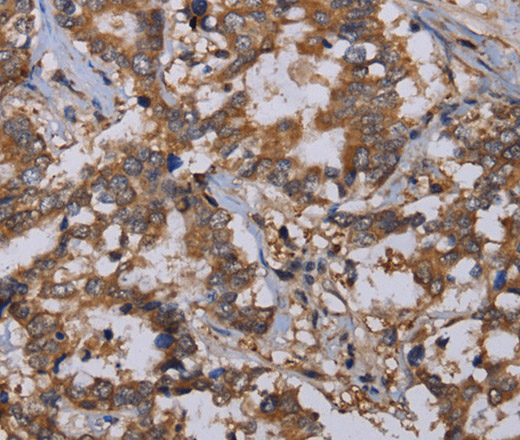 Immunohistochemistry of paraffin-embedded Human liver cancer using REG3G Polyclonal Antibody at dilution of 1:40