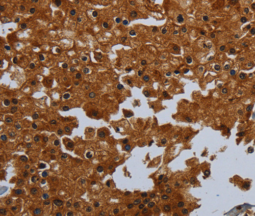 Immunohistochemistry of paraffin-embedded Human prostate cancer tissue using ENTPD7 Polyclonal Antibody at dilution 1:60