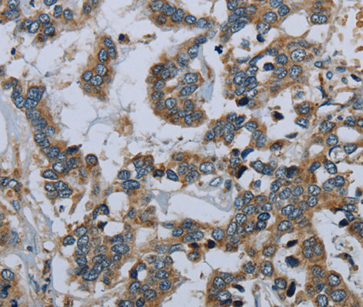 Immunohistochemistry of paraffin-embedded Human liver cancer using PCK2 Polyclonal Antibody at dilution of 1:60