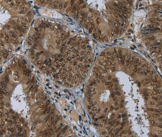 Immunohistochemistry of paraffin-embedded Human colon cancer using MRE11 Polyclonal Antibody at dilution of 1:60