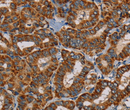 Immunohistochemistry of paraffin-embedded Human thyroid cancer using MRPL28 Polyclonal Antibody at dilution of 1:45