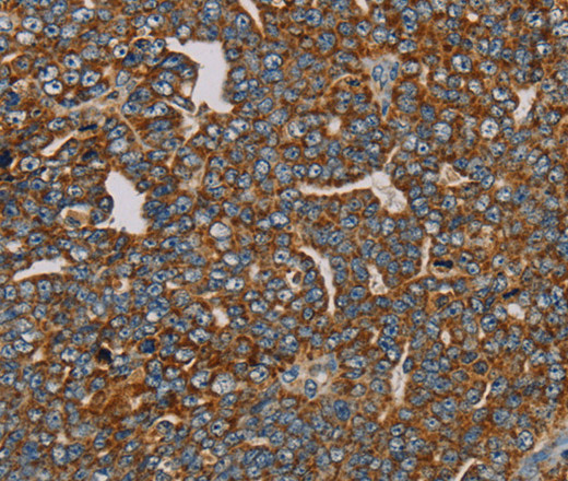 Immunohistochemistry of paraffin-embedded Human cervical cancer using MRPL28 Polyclonal Antibody at dilution of 1:45