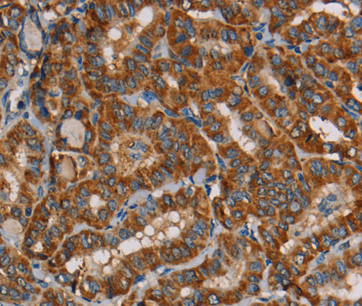 Immunohistochemistry of paraffin-embedded Human thyroid cancer using MRPL39 Polyclonal Antibody at dilution of 1:45