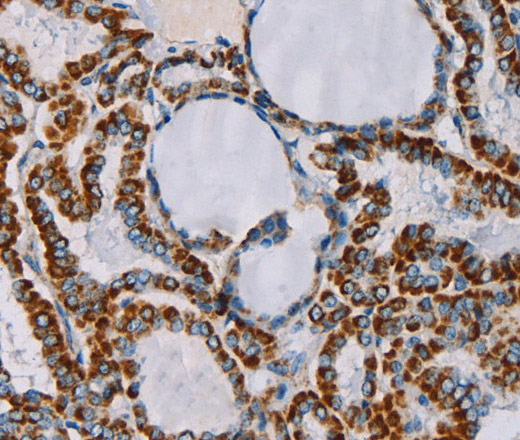 Immunohistochemistry of paraffin-embedded Human thyroid cancer tissue using CMC4 Polyclonal Antibody at dilution 1:55