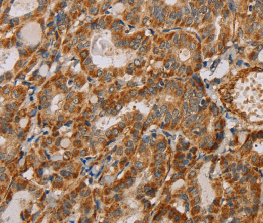 Immunohistochemistry of paraffin-embedded Human thyroid cancer using MTFR1 Polyclonal Antibody at dilution of 1:40