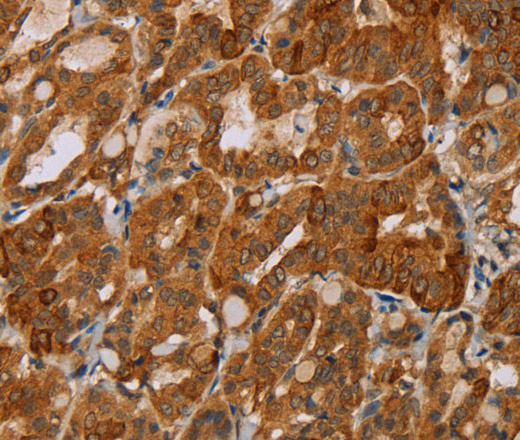 Immunohistochemistry of paraffin-embedded Human thyroid cancer tissue using MTUS1 Polyclonal Antibody at dilution 1:40