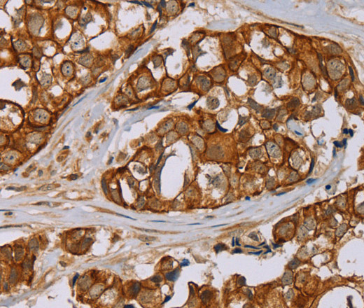 Immunohistochemistry of paraffin-embedded Human breast cancer tissue using MTUS1 Polyclonal Antibody at dilution 1:40