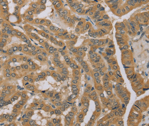 Immunohistochemistry of paraffin-embedded Human thyroid cancer using MVK Polyclonal Antibody at dilution of 1:40