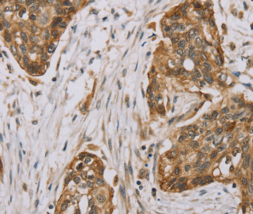 Immunohistochemistry of paraffin-embedded Human esophagus cancer using MVK Polyclonal Antibody at dilution of 1:40