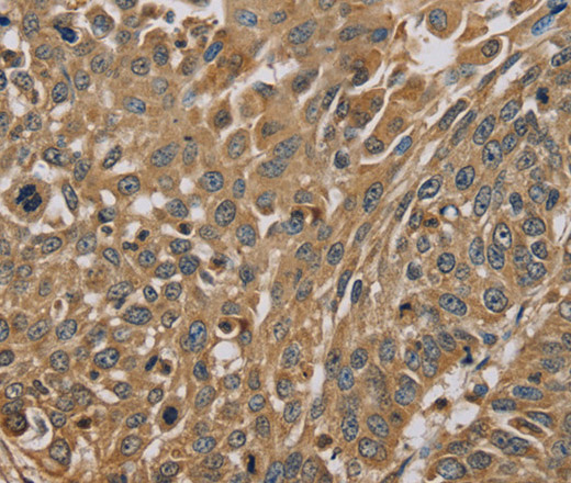 Immunohistochemistry of paraffin-embedded Human lung cancer using MYL3 Polyclonal Antibody at dilution of 1:45