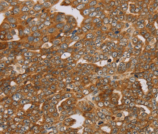 Immunohistochemistry of paraffin-embedded Human cervical cancer using PLEKHG6 Polyclonal Antibody at dilution of 1:45