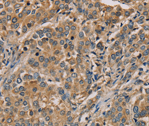 Immunohistochemistry of paraffin-embedded Human liver cancer tissue using NANOS2 Polyclonal Antibody at dilution 1:30
