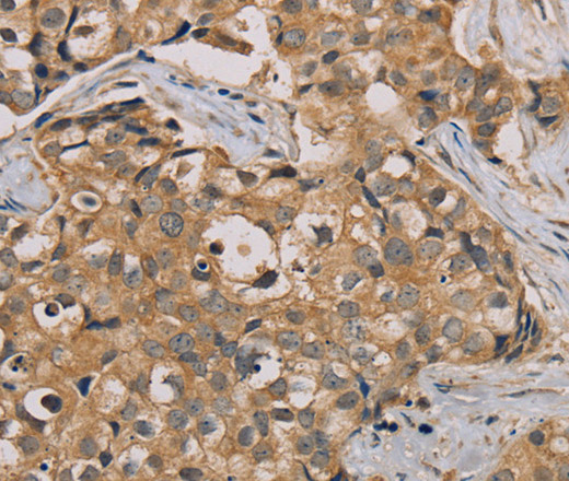 Immunohistochemistry of paraffin-embedded Human breast cancer tissue using NANOS2 Polyclonal Antibody at dilution 1:30