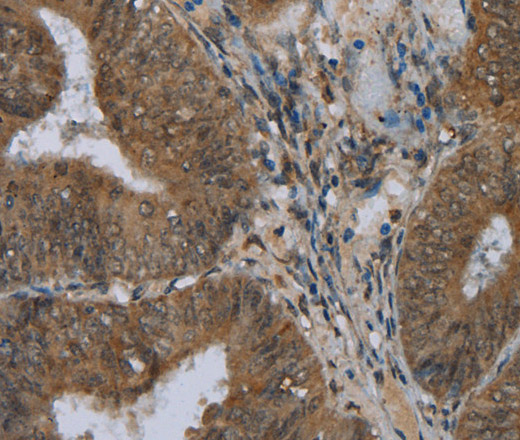 Immunohistochemistry of paraffin-embedded Human colon cancer using NAT10 Polyclonal Antibody at dilution of 1:40