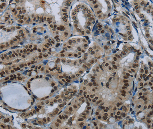 Immunohistochemistry of paraffin-embedded Human thyroid cancer tissue using DAN Polyclonal Antibody at dilution 1:50