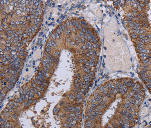 Immunohistochemistry of paraffin-embedded Human colon cancer tissue using NDUFA1 Polyclonal Antibody at dilution 1:30