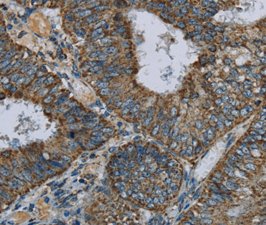 Immunohistochemistry of paraffin-embedded Human colon cancer using NDUFA5 Polyclonal Antibody at dilution of 1:60