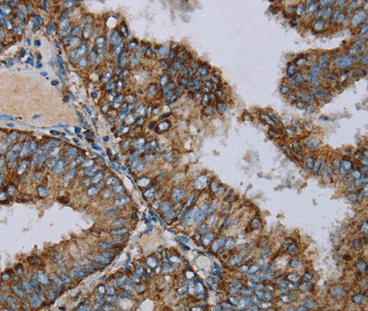 Immunohistochemistry of paraffin-embedded Human colon cancer using NDUFA9 Polyclonal Antibody at dilution of 1:30