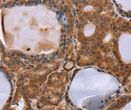 Immunohistochemistry of paraffin-embedded Human thyroid cancer using NDUFA2 Polyclonal Antibody at dilution of 1:30