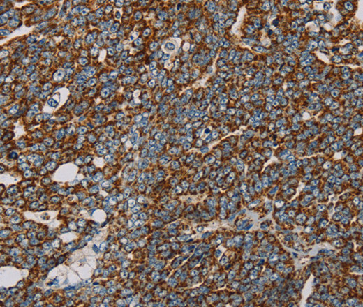 Immunohistochemistry of paraffin-embedded Human cervical cancer using NDUFS3 Polyclonal Antibody at dilution of 1:30