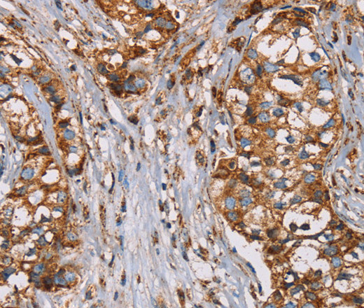 Immunohistochemistry of paraffin-embedded Human breast cancer using NDUFS1 Polyclonal Antibody at dilution of 1:50