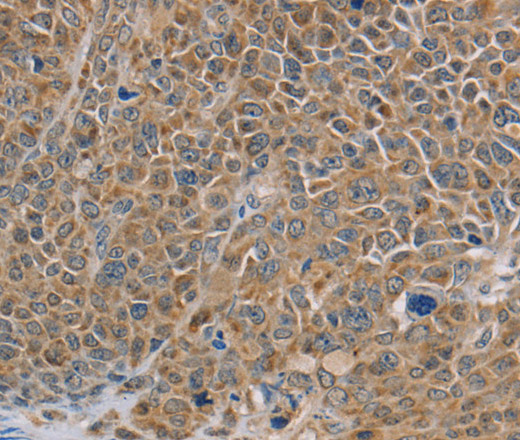 Immunohistochemistry of paraffin-embedded Human ovarian cancer tissue using NDUFS7 Polyclonal Antibody at dilution 1:40