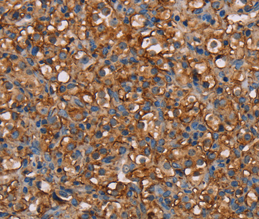 Immunohistochemistry of paraffin-embedded Human prostate cancer tissue using NEDD4L Polyclonal Antibody at dilution 1:60