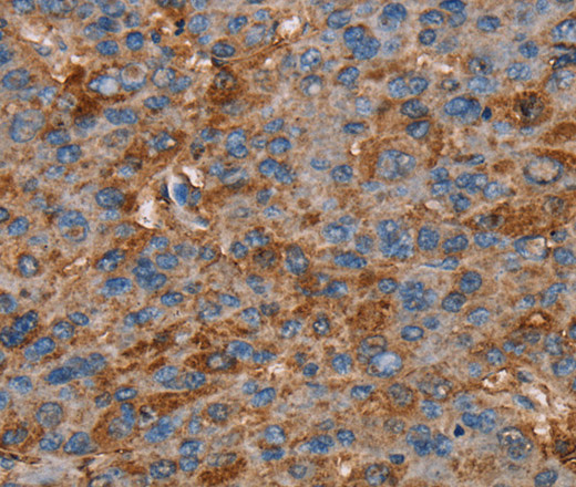 Immunohistochemistry of paraffin-embedded Human liver cancer tissue using NEDD4L Polyclonal Antibody at dilution 1:60