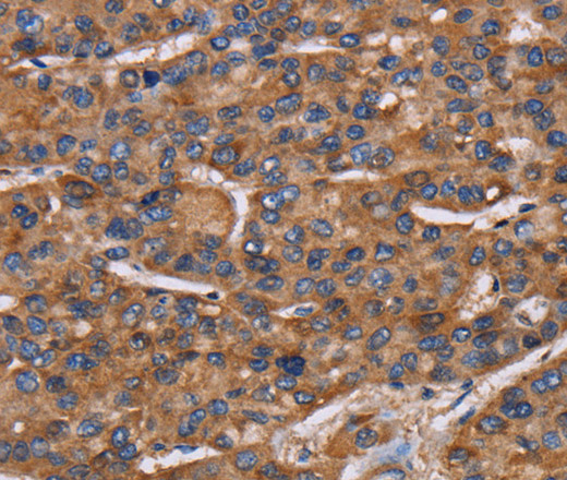 Immunohistochemistry of paraffin-embedded Human liver cancer using NCSTN Polyclonal Antibody at dilution of 1:50