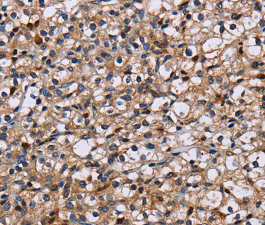 Immunohistochemistry of paraffin-embedded Human prostate cancer using NCSTN Polyclonal Antibody at dilution of 1:50