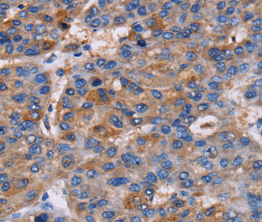 Immunohistochemistry of paraffin-embedded Human liver cancer using NPM3 Polyclonal Antibody at dilution of 1:60