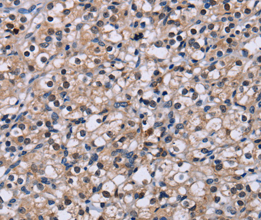 Immunohistochemistry of paraffin-embedded Human prostate cancer tissue using NR1D1 Polyclonal Antibody at dilution 1:60