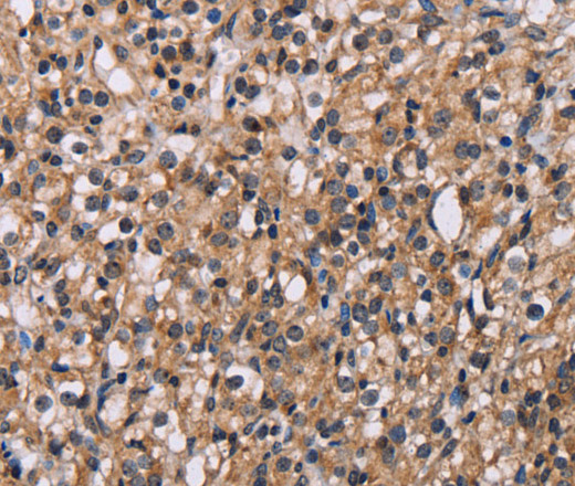 Immunohistochemistry of paraffin-embedded Human prostate cancer using GNL3 Polyclonal Antibody at dilution of 1:60