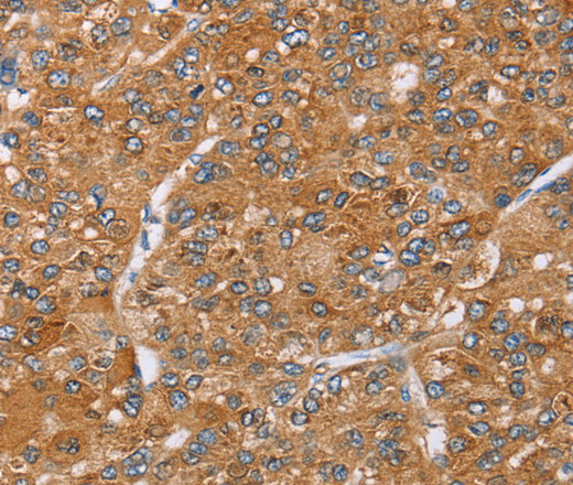 Immunohistochemistry of paraffin-embedded Human liver cancer using PAICS Polyclonal Antibody at dilution of 1:35