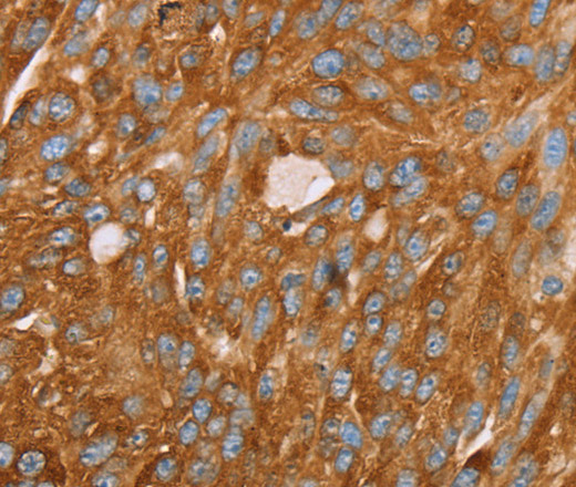 Immunohistochemistry of paraffin-embedded Human breast cancer using PAICS Polyclonal Antibody at dilution of 1:35