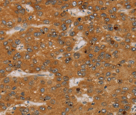 Immunohistochemistry of paraffin-embedded Human liver cancer tissue using PARP3 Polyclonal Antibody at dilution 1:40