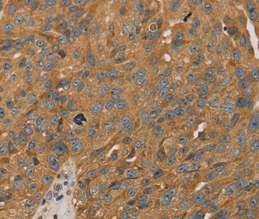 Immunohistochemistry of paraffin-embedded Human breast cancer tissue using PARP11 Polyclonal Antibody at dilution 1:30