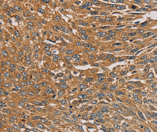 Immunohistochemistry of paraffin-embedded Human lung cancer tissue using PARP11 Polyclonal Antibody at dilution 1:30