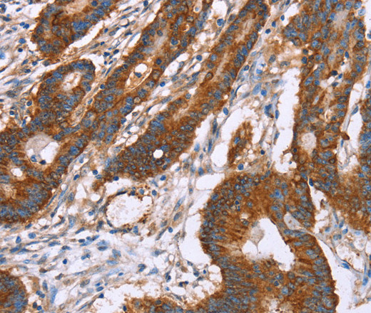 Immunohistochemistry of paraffin-embedded Human colon cancer using CLP36 Polyclonal Antibody at dilution of 1:30