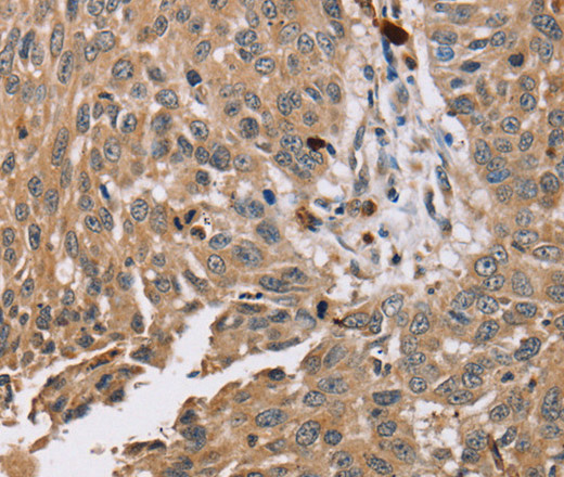 Immunohistochemistry of paraffin-embedded Human lung cancer tissue using PDLIM7 Polyclonal Antibody at dilution 1:35