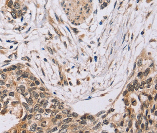 Immunohistochemistry of paraffin-embedded Human esophagus cancer tissue using PDLIM7 Polyclonal Antibody at dilution 1:35