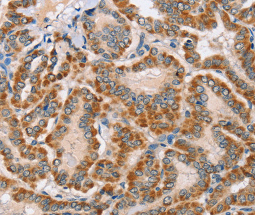 Immunohistochemistry of paraffin-embedded Human thyroid cancer using MSMB Polyclonal Antibody at dilution of 1:30