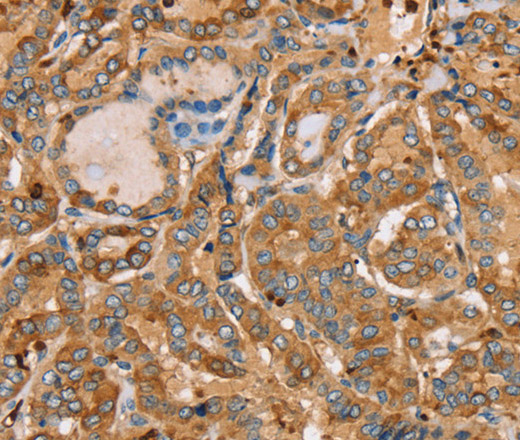 Immunohistochemistry of paraffin-embedded Human thyroid cancer using PLS3 Polyclonal Antibody at dilution of 1:30