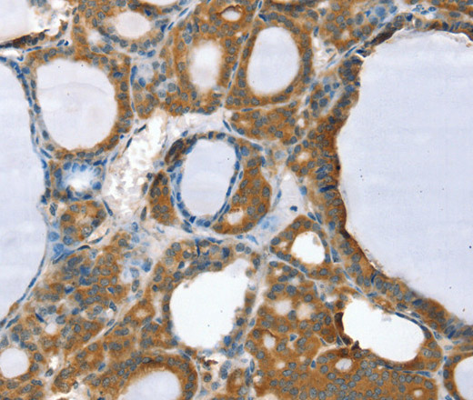 Immunohistochemistry of paraffin-embedded Human thyroid cancer using PPP2CA Polyclonal Antibody at dilution of 1:35